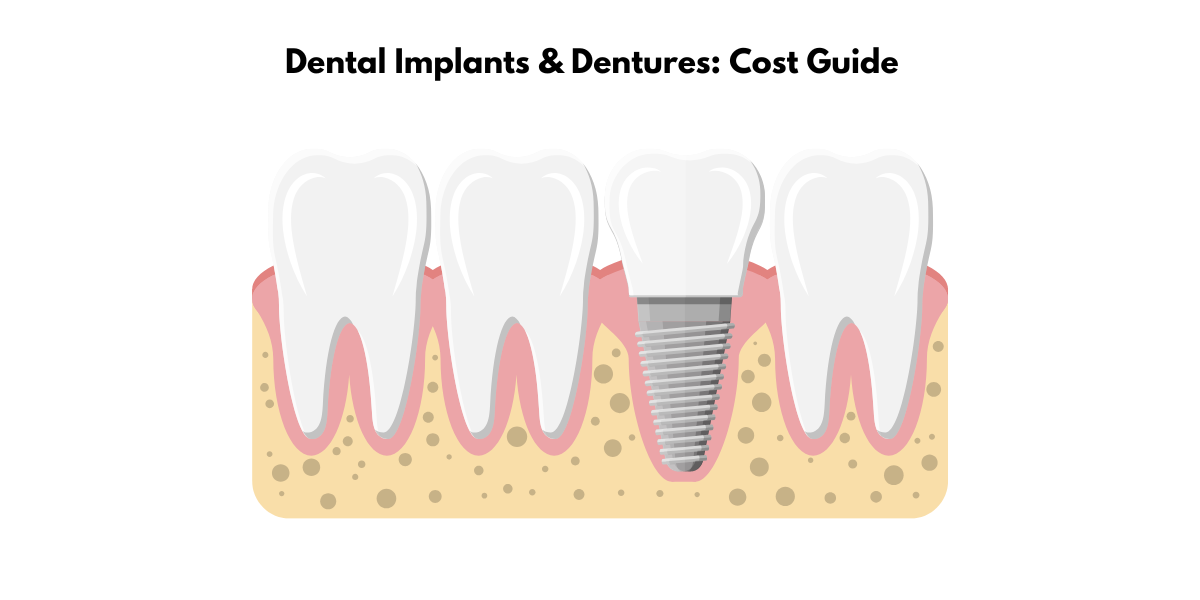 Affordable Dental Implants and Dentures: Your Ultimate Cost Guide