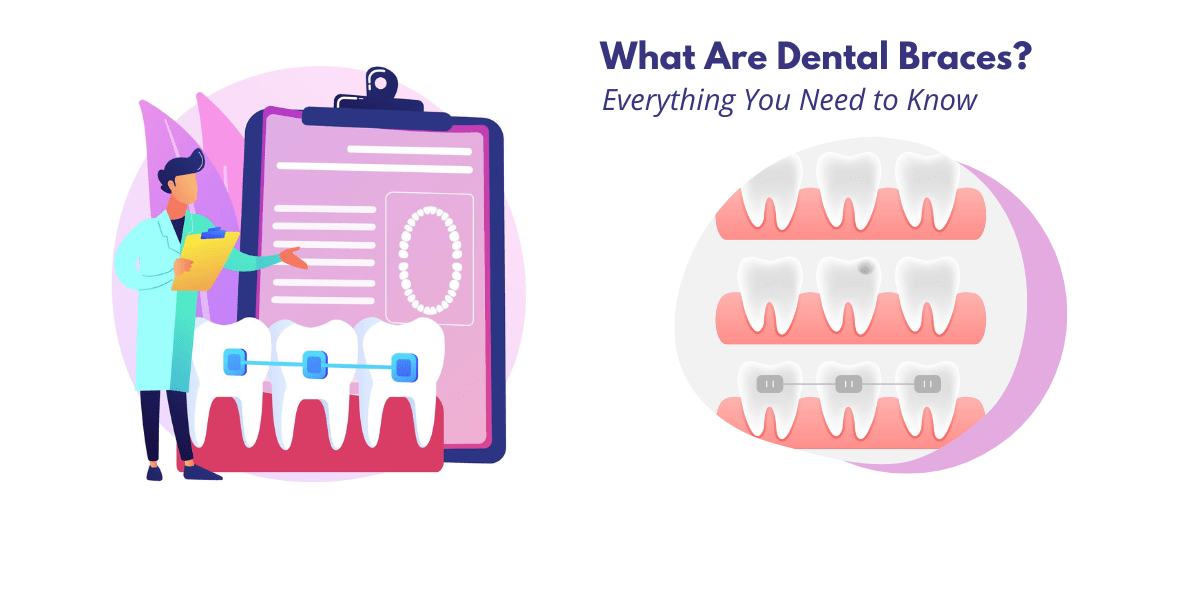All You Need to Know About Dental Braces: Types, Cost, How They Work, and More